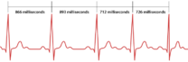Diagram showing variable intervals between heartbeats in milliseconds over several heartbeats. T